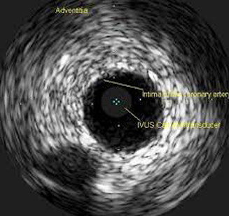 Intravascular Ultrasound