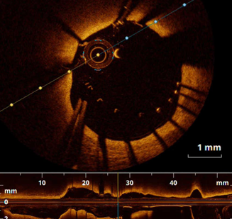 Optical Coherence Tomography
